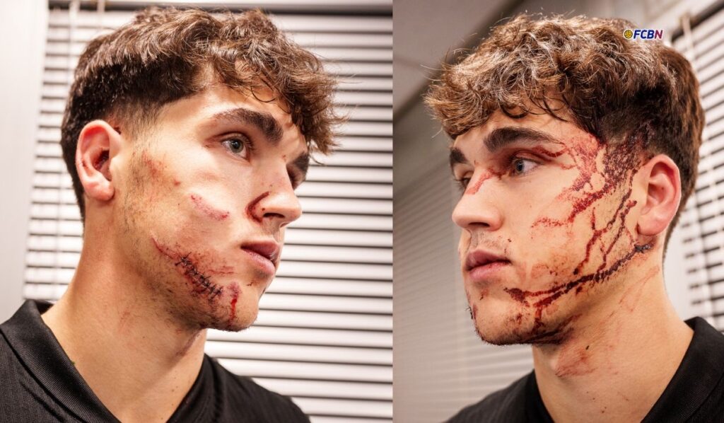 Pau Cubarsí set off alarm bells in Barcelona after suffering a brutal kick to the face