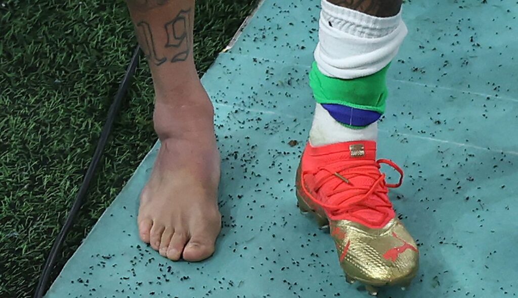 El tobillo de Neymar tras una fuerte entrada de un defensor serbio