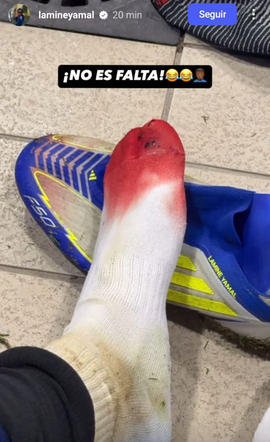 Así quedó el pie de Lamine Yamal tras el UD Las Palmas-FC Barcelona